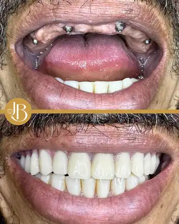 Caso clínico 11: antes e depois, publicado pela JB Implantologia